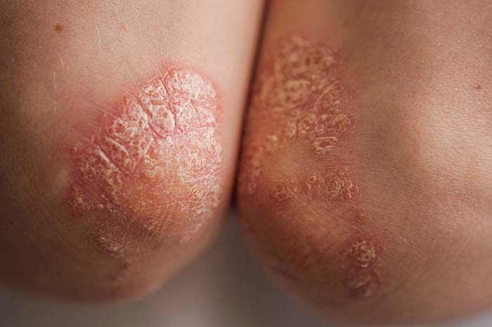 Psoriasis pour la peau