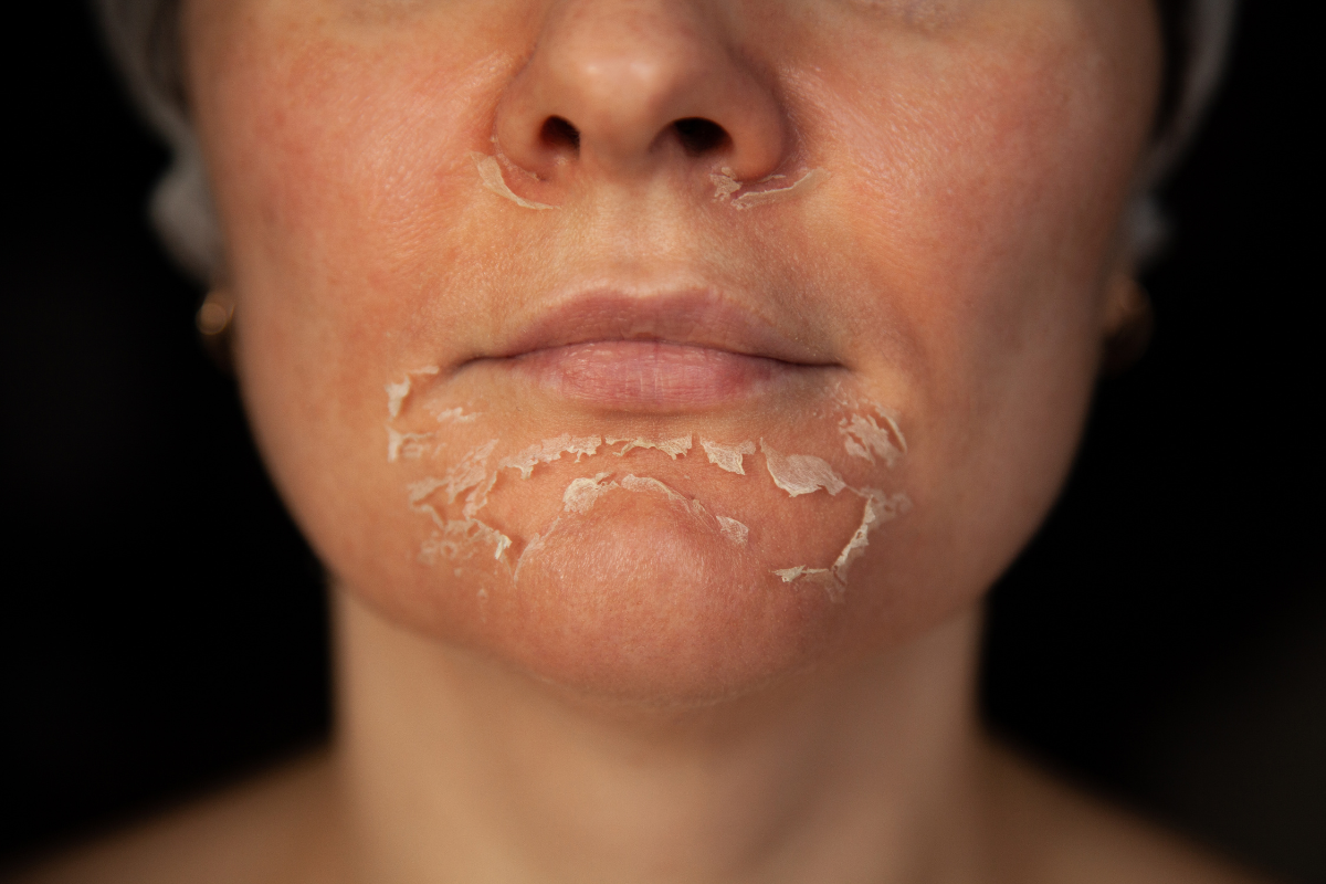 Peeling au rétinol Avantaprès et résultats