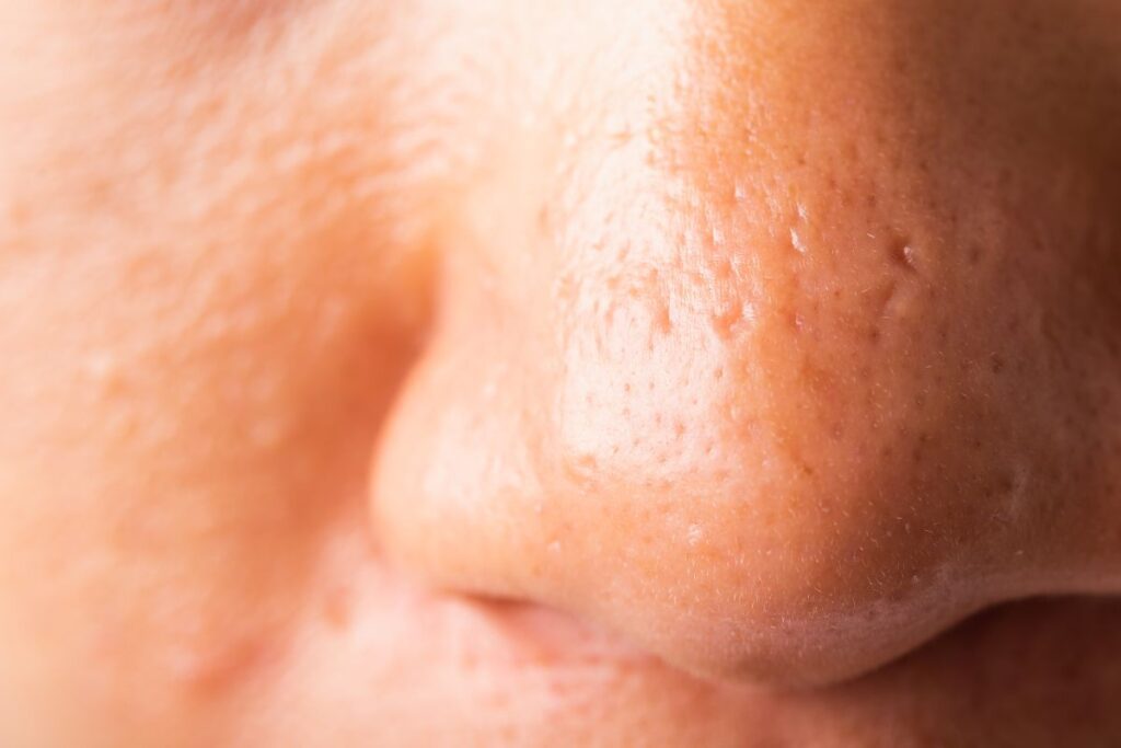 avis dermatologue comment resserrer pore du visage